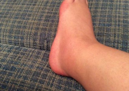 Важно не запускать заболевание Отечность ног может указывать на проблемы со здоровьем