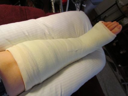 Для скорейшего выздоровления стоить не нагружать себя Гипс ноги при переломе