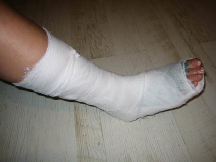 Если есть смещения, врач сопоставляет отломки кости Гипс при переломе стопы