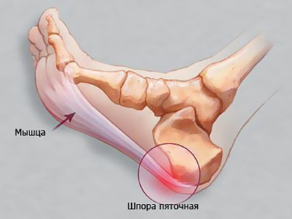 Для укрепления мышц необходима постоянная тренировка Боль при пяточной шпоре