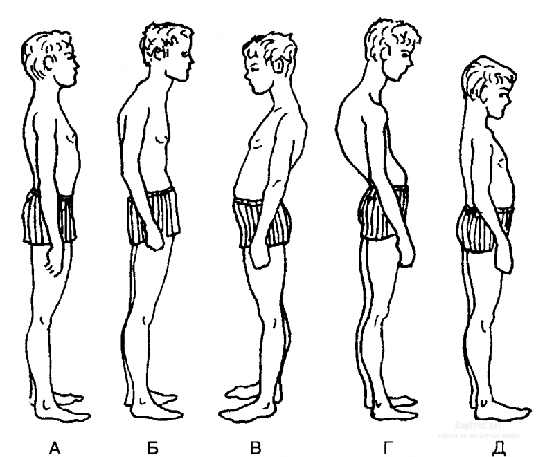 Идиоматический сколиоз
