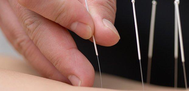 Иглоукалывание