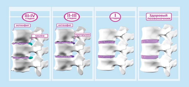 Степени остеохондроза