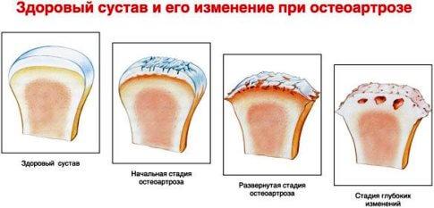 остеоартроз