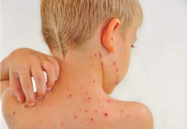 cиндром Стилла