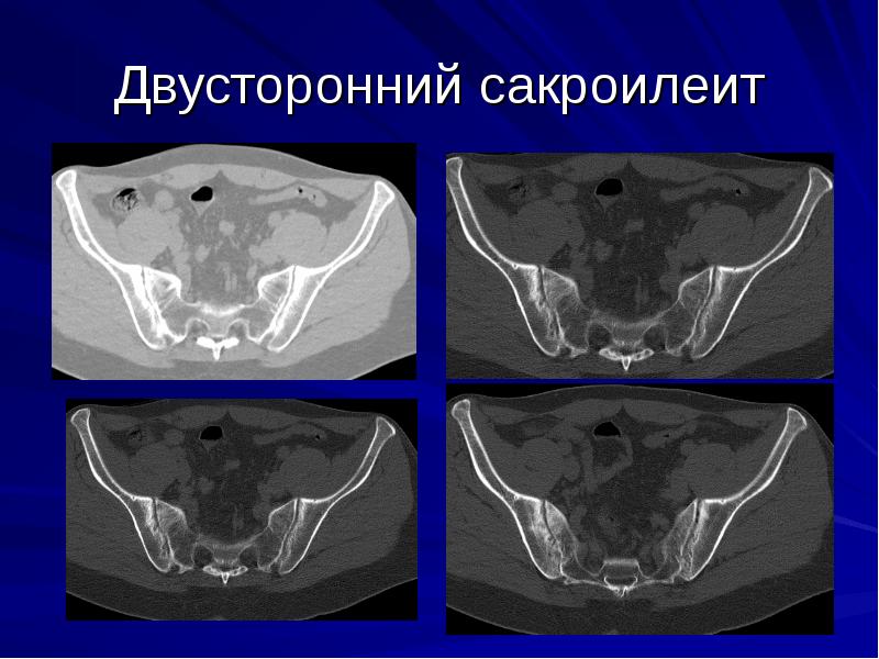 Двусторонний Сакроилеит