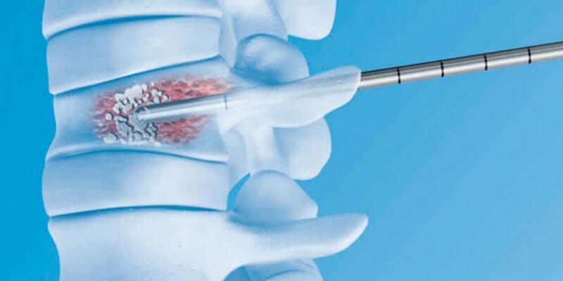 Гемангиома позвонка