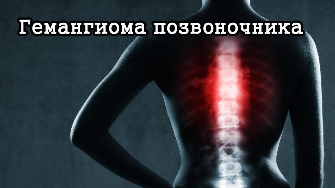 Гемангиома позвоночника