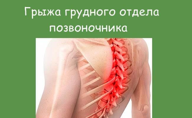 Грыжа грудного сегмента позвоночника