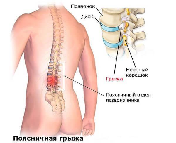 Грыжа в области поясничных дисков