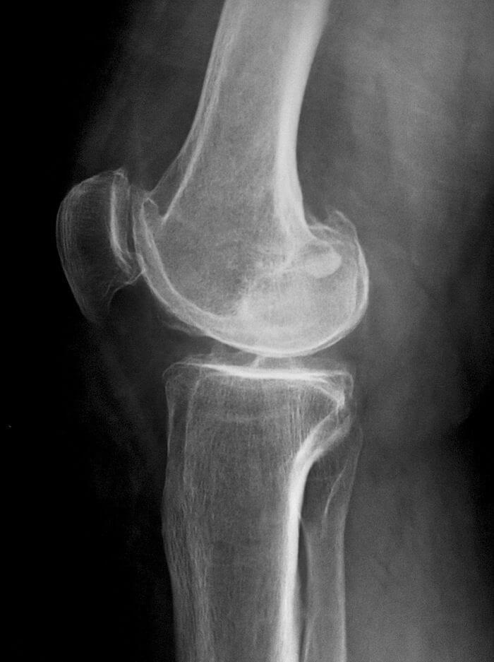 Лечение хондропатии хондропатия коленного сустава