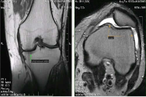 МРТ коленного сустава