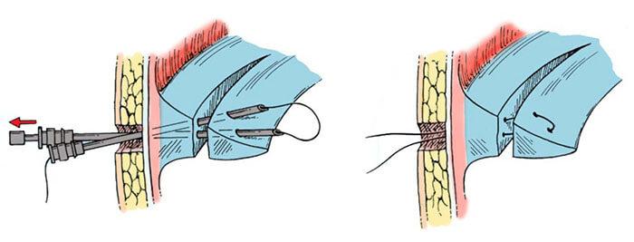 Операция артроскопии