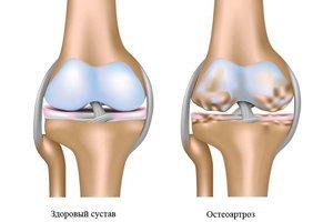 Остеоартроз