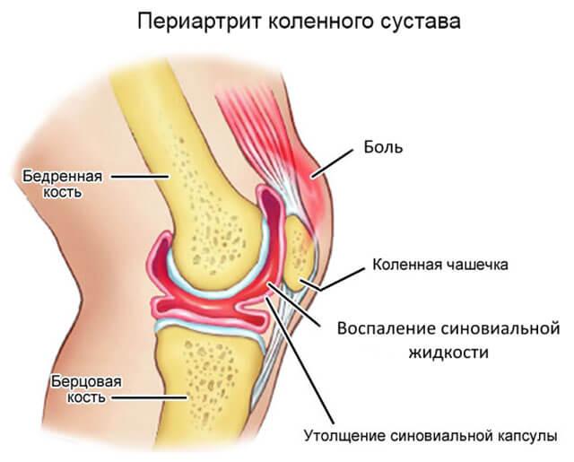 Периартрит коленного сустава