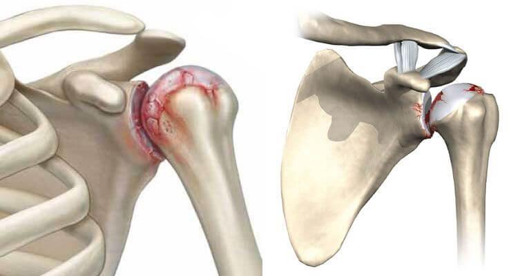 Плечевой артроз