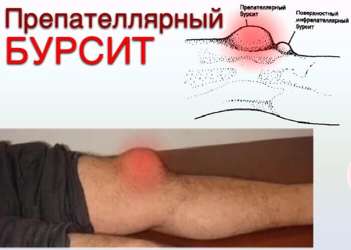 Препателлярный Бурсит