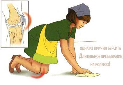 Причина появления бурсита коленного сустава
