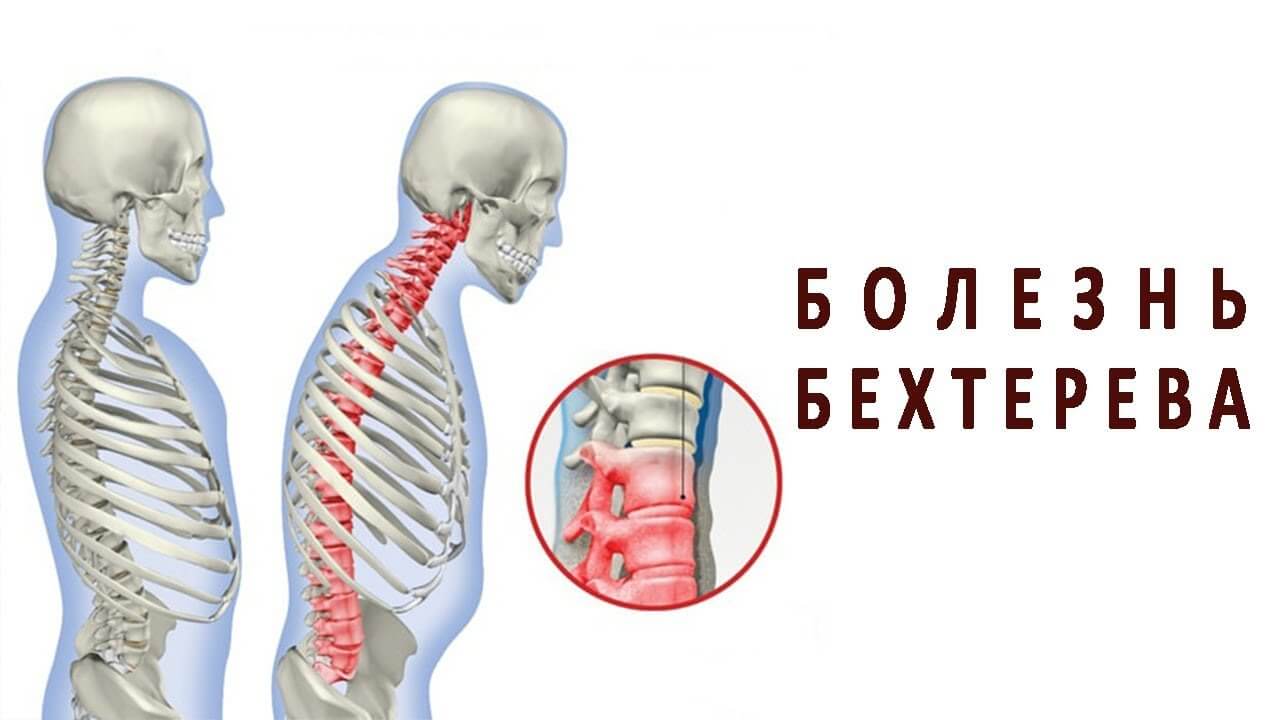 болезнь Бехтерева