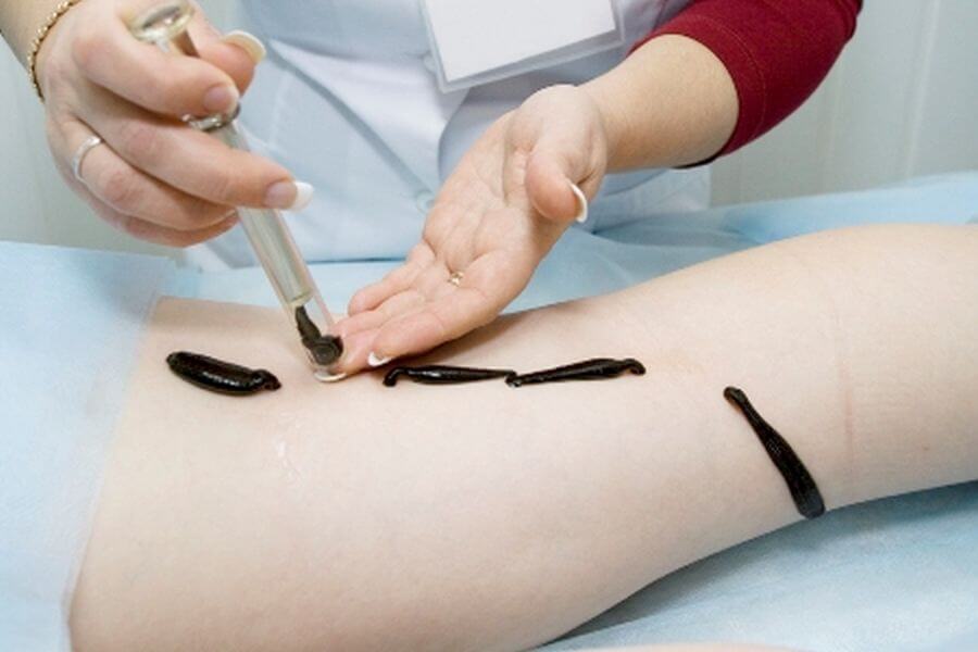 Гирудотерапия