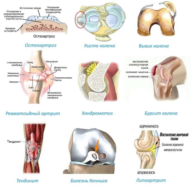 болезни коленного сустава
