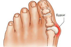 Бурсит в ноге