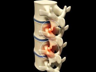 Мифы о спондилезе