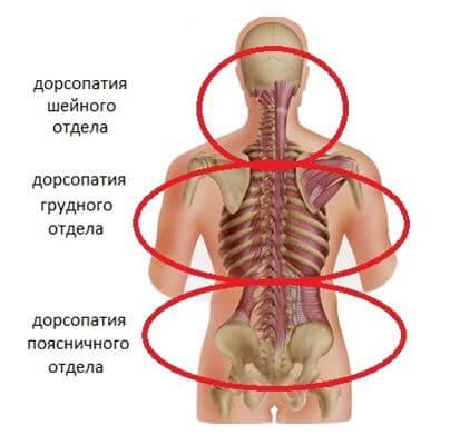дорсопатия