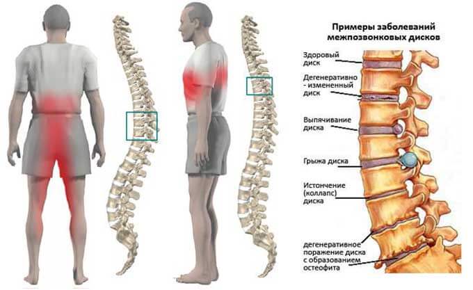 грыжа позвоночника