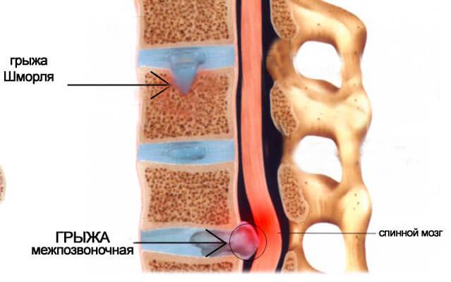 грыжа шморля