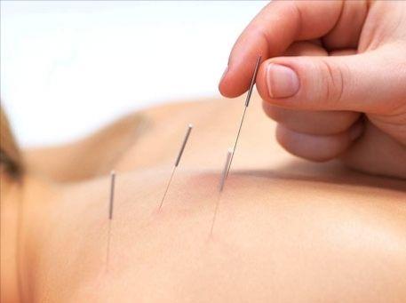 Иглоукалывание