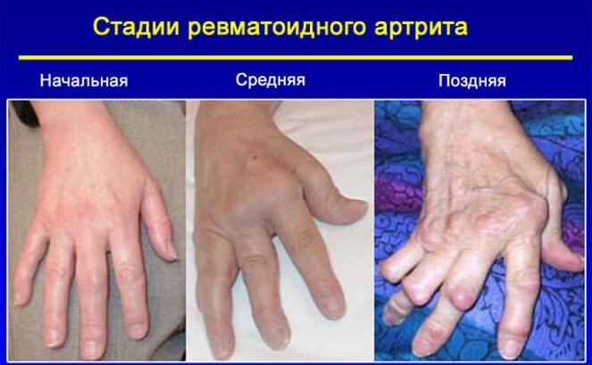 ревматоидный артрит