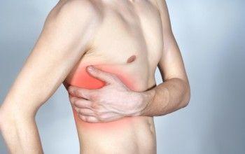 Межреберный хондроз