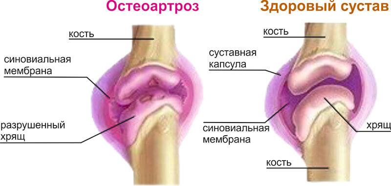 остеоартроз