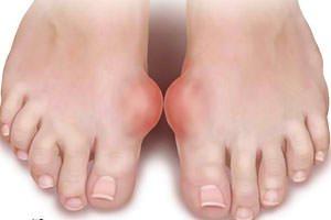 Заболевание подагры