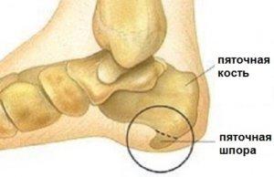 Шпора на пятке