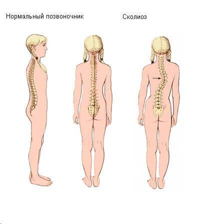 Врожденный сколиоз