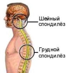 Симптомы шейного спондилеза