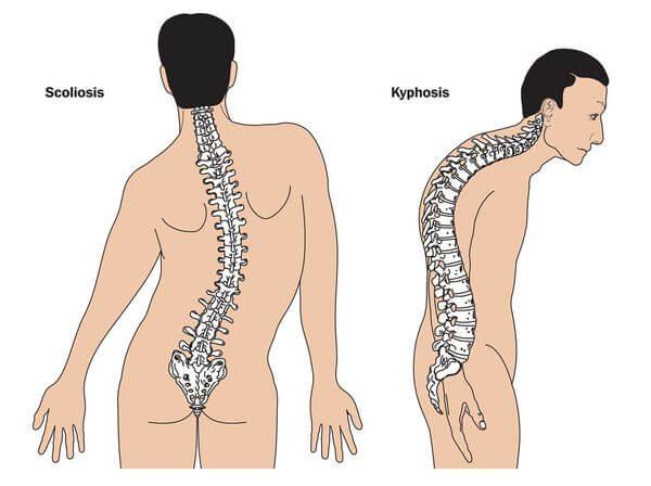 синдром Марфана