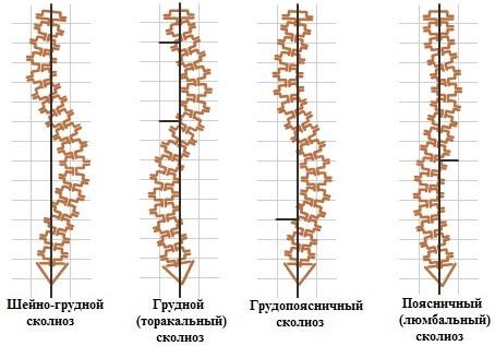 Диспластический вид сколиоза