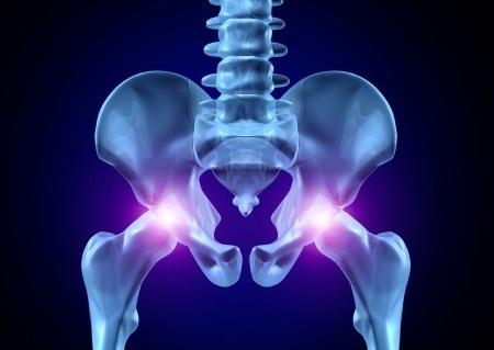 Заболевание коксартрозом