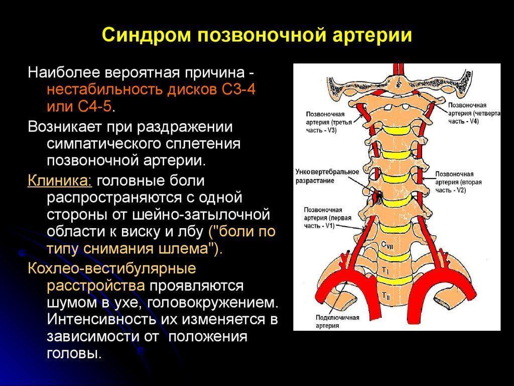 Синдром позвоночной артерии